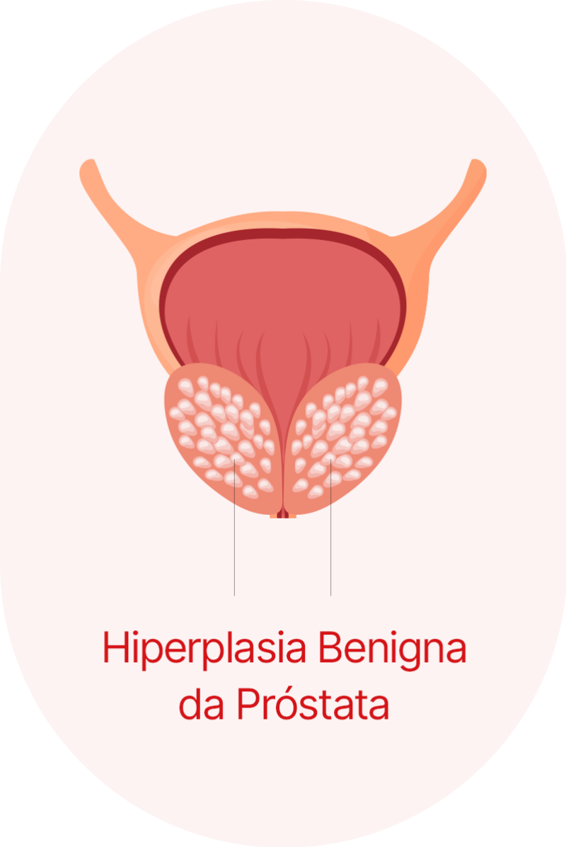 Hiperplasia Benigna da Próstata