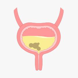 Litíase urinária (“Pedras”) no ureter ou bexiga